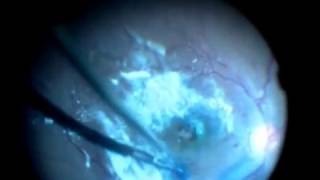 Management of Large Macular hole