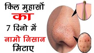किल मुहासों का 7 दिनों में नामो निसान मिटाए  Get Rid of Pimples at home