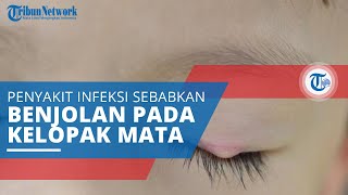 Bintitan, Infeksi Mata yang Membuat Penderitanya Mengalami Benjolan Kecil di Luar Kelopak Mata