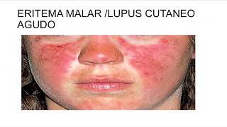 Introducción a las enfermedades Autoinmunes Sistémicas (Dra. Consani)