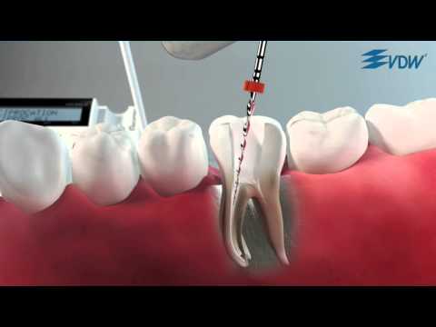 VDW Dental · How To: RECIPROC - Reverse Comfort Function