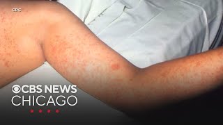 Kane County identifies two possible measles exposure sites after confirmed case