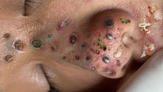 Loan Nguyen Acne Treatment 10.