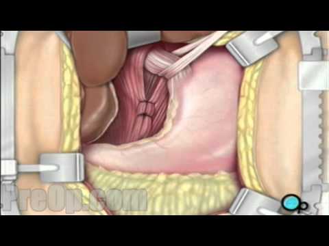Hernia - Hiatal Open Repair Surgery PreOp® Patient Education