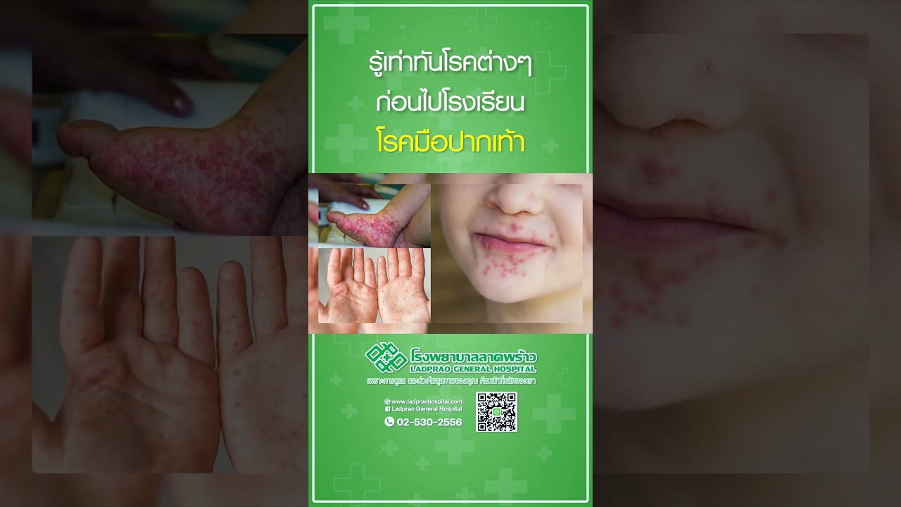โรค มือ ปาก เท้า  #โรงพยาบาลลาดพร้าว #โรคมือเท้าปาก #โรคในหน้าฝน
