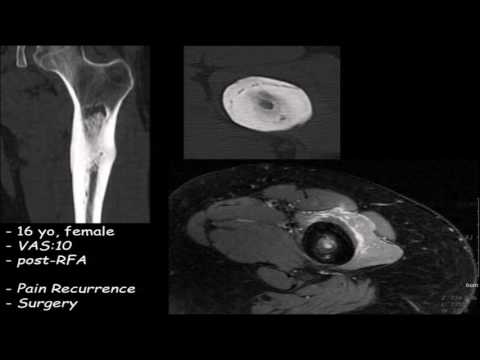 Maayan Kimhy - MRgFUS Treatment of Osteoid Osteoma: a Prospective Development Study. (2016)