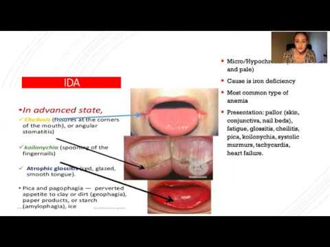 Anemia EXPLAINED | Iron, B12, & More (NP Boards)