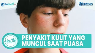 Waspadai Penyakit Kulit yang Kerap Muncul saat Menjalani Puasa, Satu di antaranya Kulit Kering