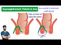 Suprasphincteric Fistula In Ano Successful Treatment With Seton Dr Tayyab Riaz Ch