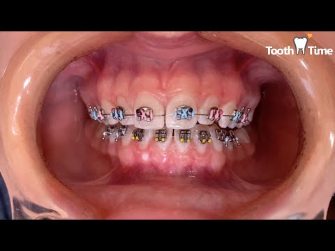 How they put braces on - 15 years old patient - Tooth Time Family Dentistry New Braunfels Texas