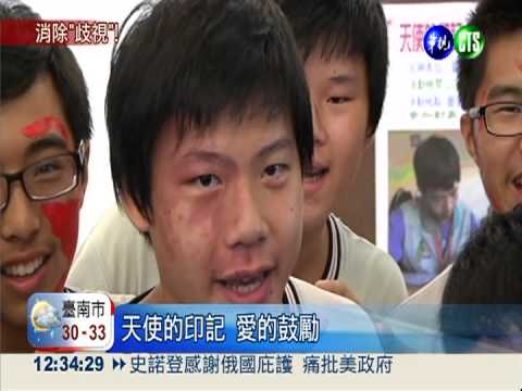 同學我挺你! 百人塗紅臉挺胎記生