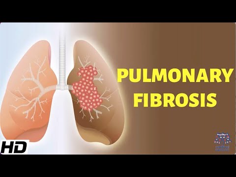 Pulmonary Fibrosis: Everything You Need To Know