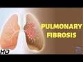 Pulmonary Fibrosis: Everything You Need To Know