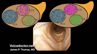 Case study: Lateral cricoarytenoid paresis