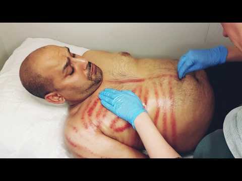 Jacina Acupuncture video.