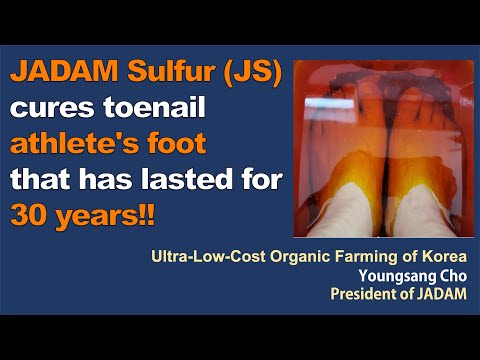 JADAM Sulfur (JS) cures toenail athlete's foot that has lasted for 30 years!!