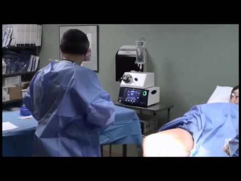 Vein Ablation By Dr Shammas from MCRF