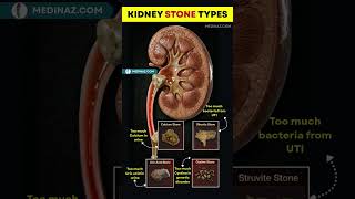 This Is What Kidney Stones Actually Look Like! 😳
