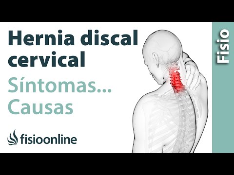 ¿Qué es la hernia discal cervical y cuáles son sus causas y síntomas?