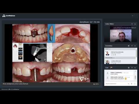Soft Tissue Institute - Wszczepianie implantów w pełnej nawigacji - webinar 3. Łukasz Bańczyk