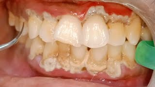Dental Scaling of Tartar Affecting Gums Badly🤢🥵.  Amazing Results after Plaque Removal. Dr Ram MDS