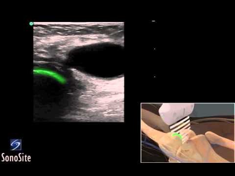 Beule auf dem Gelenk der großen Zehe als heilen Insbesondere Ernährung mit Osteochondrose