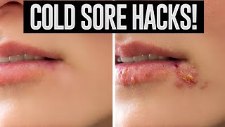 Cold Sore Hacks: Curing Cold Sores Overnight? 8 Proved Hacks To Treat Cold Sores