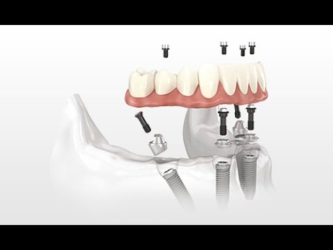 All-on-4 Dental Implants