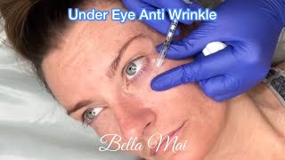 3 Areas & Under Eye (Jelly Roll) Anti Wrinkle (Botox) -  Before, During & After