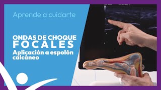 Aplicación de ondas de choque focales a espolón calcáneo