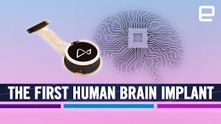 Elon Musk’s Neuralink brain implant: New era of Brain-Computer Interface (BCI) technology