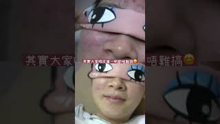 客人個案:皮膚敏感性暗瘡,試過好多方法都唔得,而家兩個月暗瘡同敏感肌都改善咗好多,其實要明白皮膚差嘅原因先可以改善皮膚,記住一定要令皮膚回復健康呀#暗瘡 #針清 #暗瘡印 #敏感肌 #凹凸洞