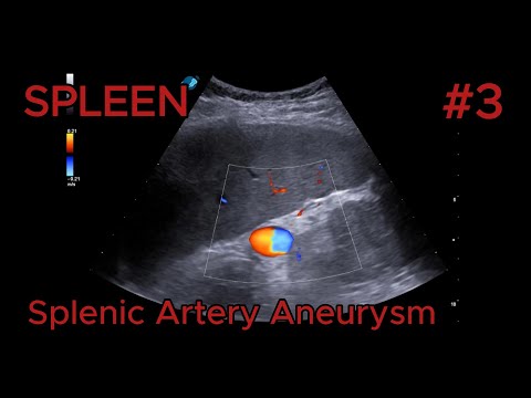 Splenic artery aneurysm video preview