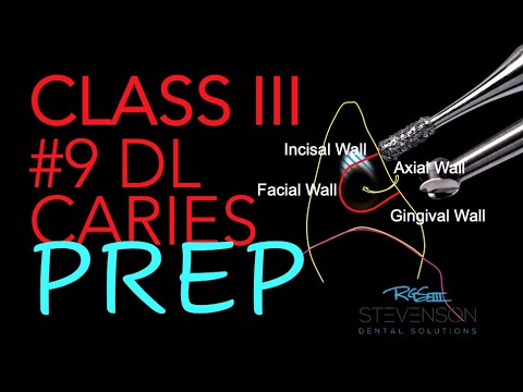 Class III Composite #9 DL Preparation