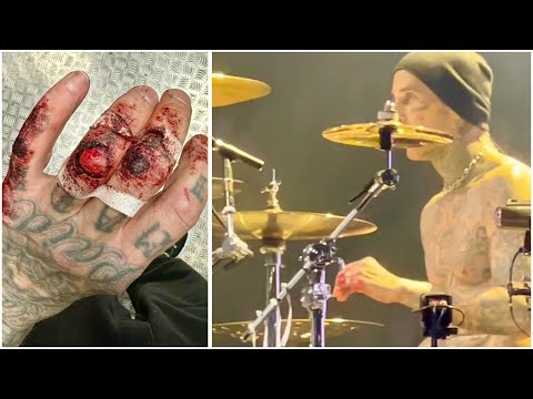 Travis Barker Drumming Injury - Blink-182