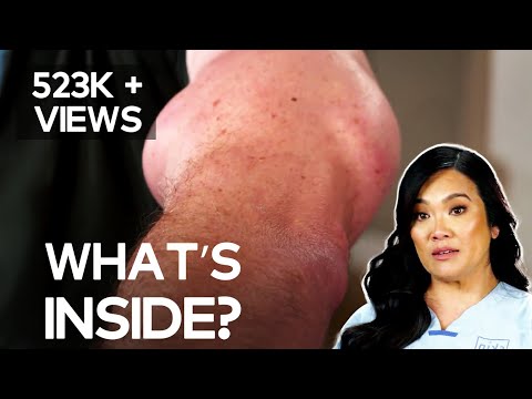 Hanging by a Thread? | Dr. Pimple Popper TLC
