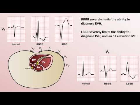 Intro to EKG Interpretation - Bundle Branch Blocks