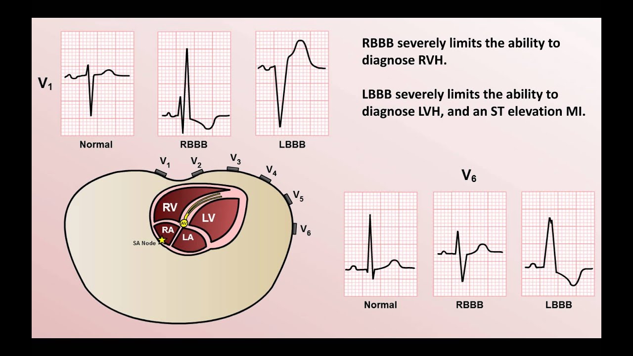 Intro to EKG Interpretation - Bundle Branch Blocks