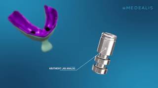 Docklocks (Medealis) 2 implants, Mandible