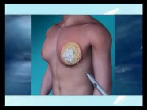 Gynecomastia
