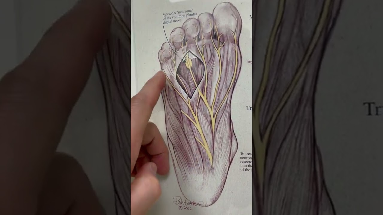 Tarsal Tunnel Release After Baxter's Neuropathy Dr. Eric H. Williams