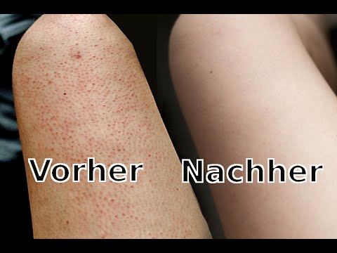 Finally beautiful skin 😀 what helps me against my sandpaper skin / pimples on my arms and legs