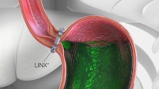 Watch the video - Medical Insight: LINX® Reflux Management System – Essentia Health