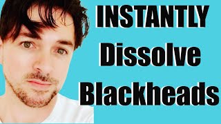 INSTANT Blackhead Removal | Removing Blackheads From Nose / Face | CHRIS GIBSON