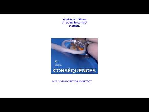 Pourquoi le Fenderwedge est indispensable ? – Matériel