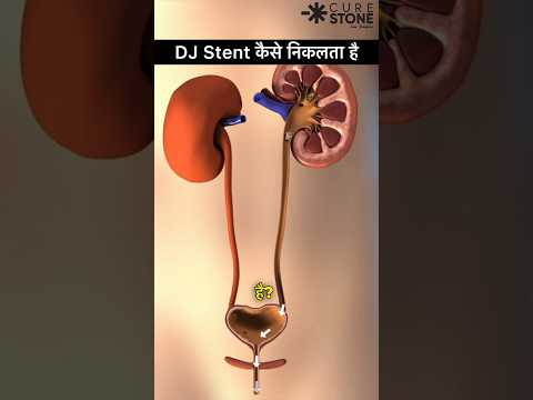 DJ Stent Removal | Retrograde Intrarenal Surgery | kidney stone treatment #shorts