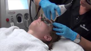 VBeam® - Lafayette, LA - Dr. Cynthia Glass