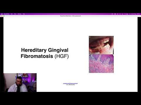 Hereditary Gingival Fibromatosis Explained