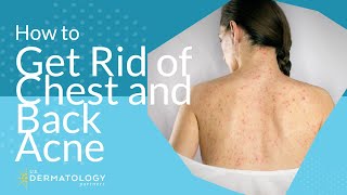 How to Get Rid of Chest and Back Acne