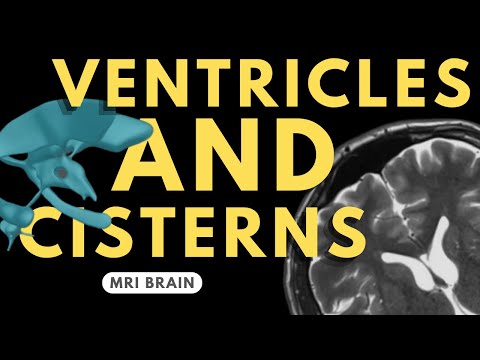 Ventricles and Cisterns of the Brain | Radiology anatomy part 1 prep | MRI brain